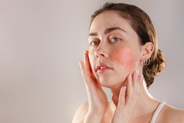 What Is Skin Redness?