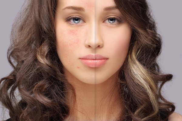 How to Get Rid of Redness From Acne