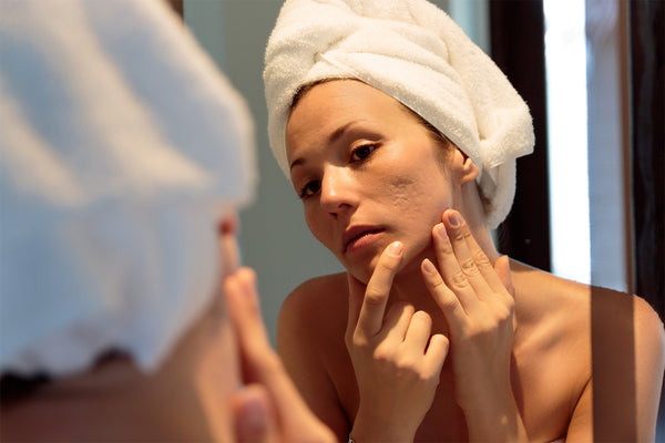How Do You Get Rid of Acne Scars for Clearer Skin?